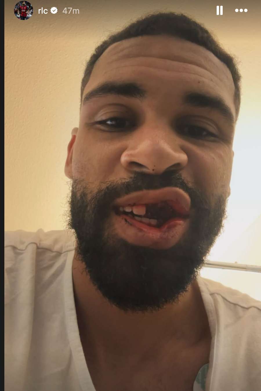 Loftus-Cheek dopo il trauma facciale Loftus-Cheek dopo il trauma facciale