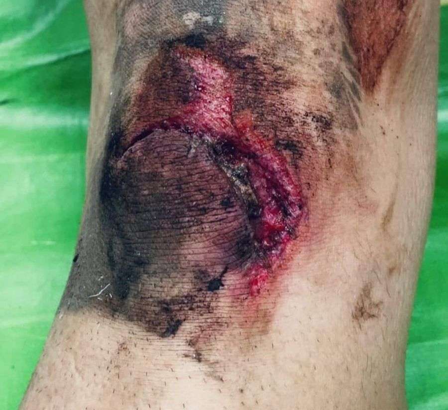 Genunchiul lui Florin Haită fotografiat după meci Genunchiul lui Florin Haită fotografiat după meci