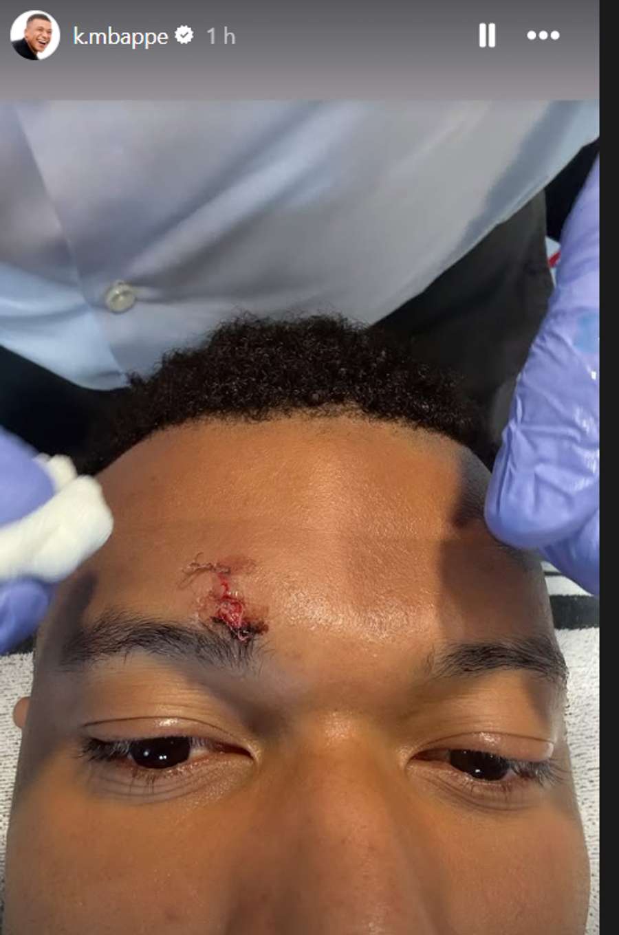 Mbappé, tras recibir puntos entre la ceja y la frente