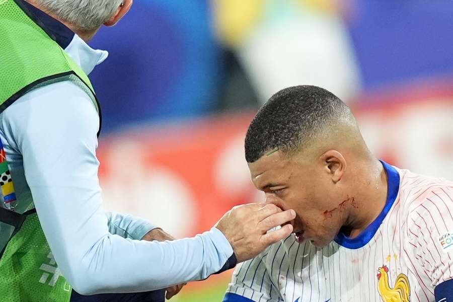 Kylian Mbappe har brækket næsen, men kan fortsætte ved slutrunden.