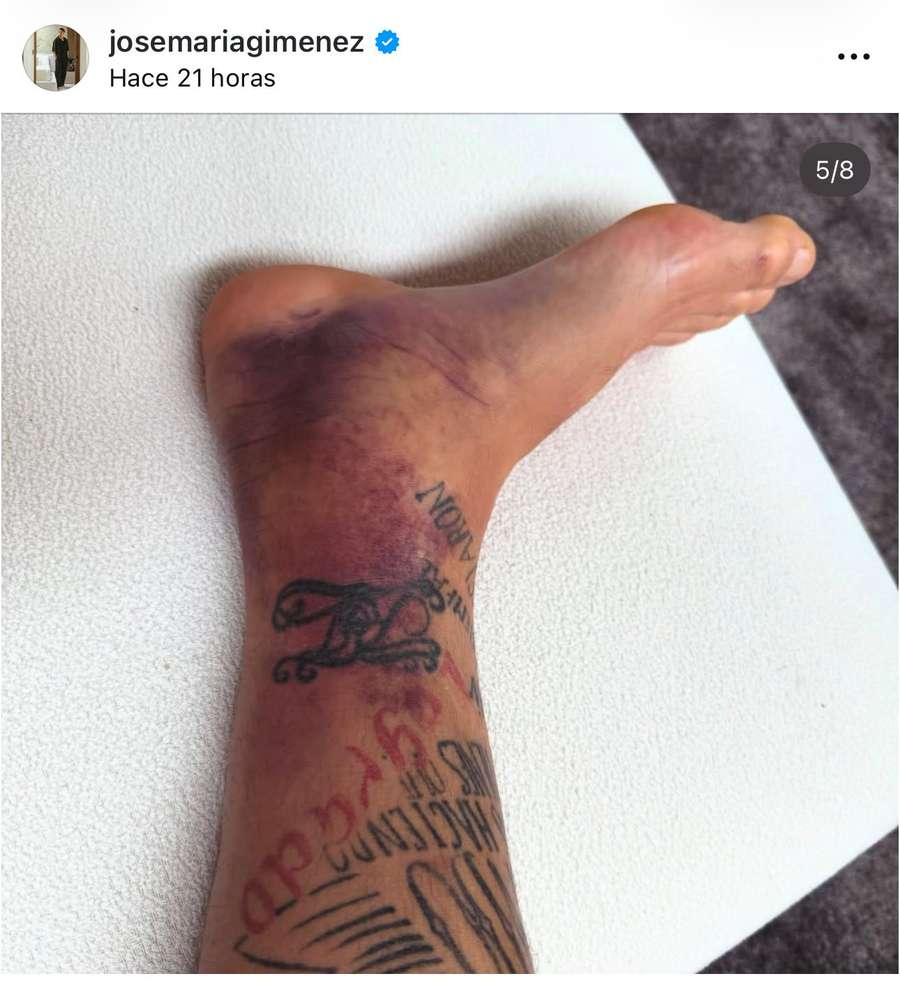 El tobillo de Giménez