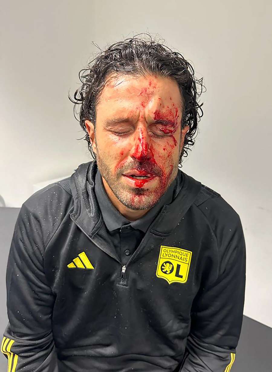 This handout picture released by Lyon shows their injured Italian coach Fabio Grosso after being hit by various projectiles when the team's bus was stoned