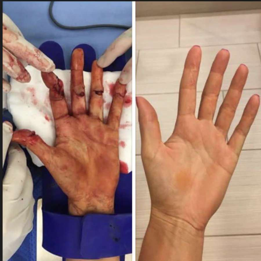 Antes e depois da cirurgia Antes e depois da cirurgia