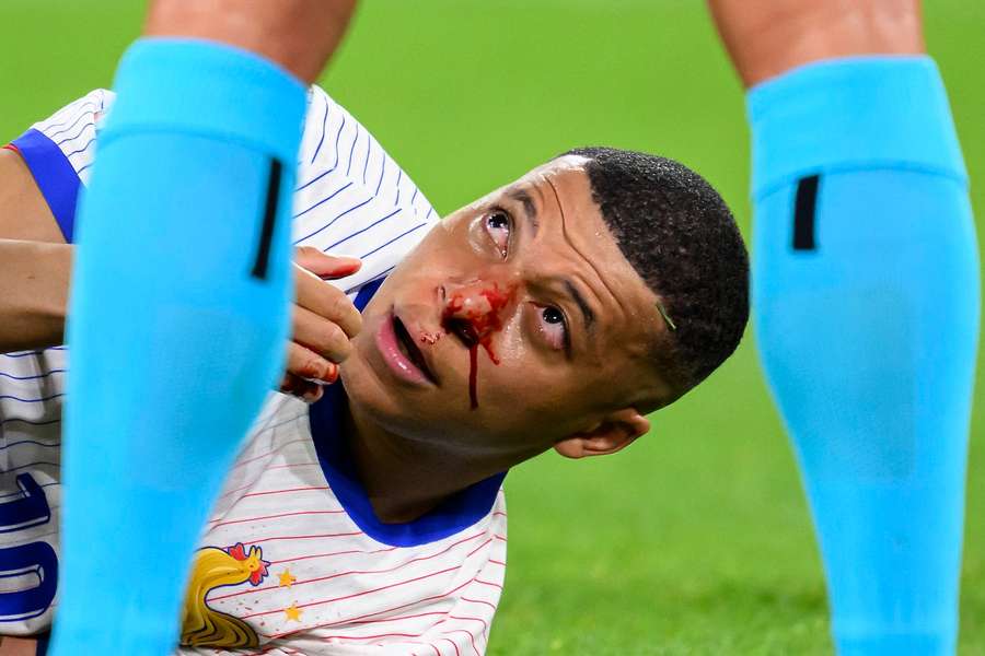 Kylian Mbappe zog sich am Montag gegen Österreich eine schmerzhafte Verletzung zu.